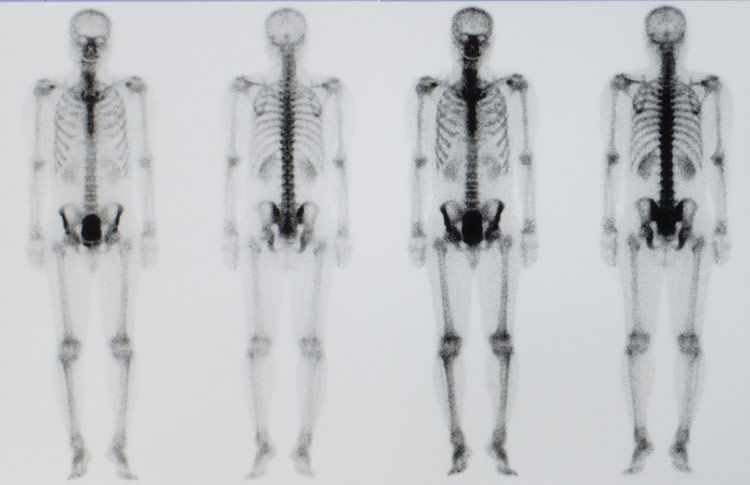 Bone scan