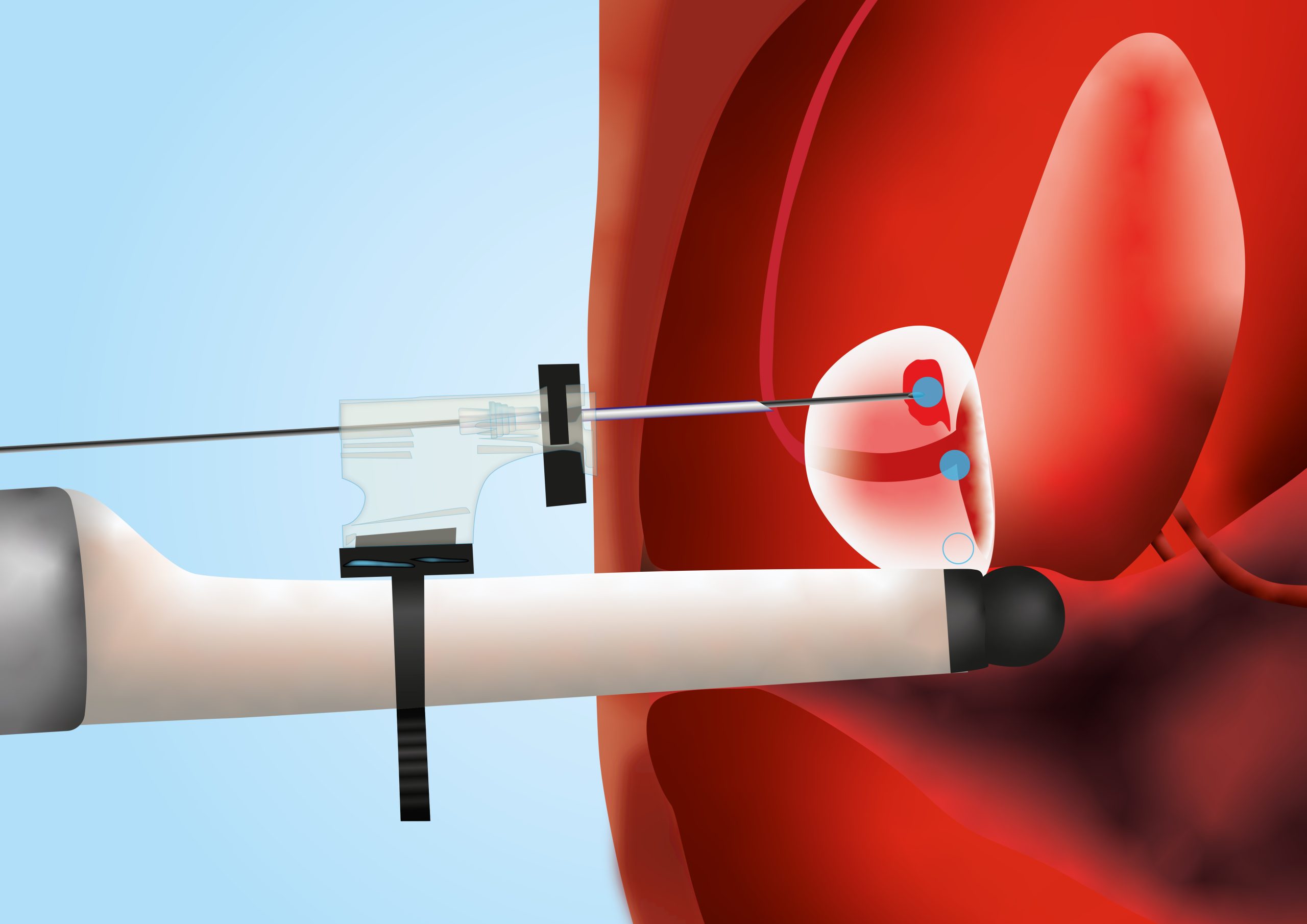 Ultrasound examination and transperineal prostate biopsy